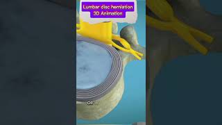 Lumbar Disc Herniation Causes Symptoms amp Treatment  Back Pain Reliefbackpain herniateddisc [upl. by Neelak537]