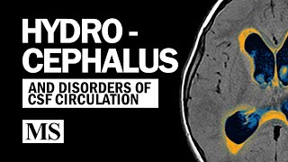 Hydrocephalus And the Disorders of CSF Circulation [upl. by Yuji]