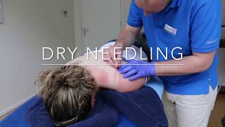 Dry Needling bij Fitaal Fysiotherapie Heerenveen [upl. by Edeline]