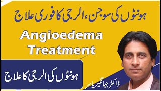 Honton ki allergy ka ilaj  How to Get Rid of Swollen Lips  Angioedema Treatment in Urdu [upl. by Eaton]