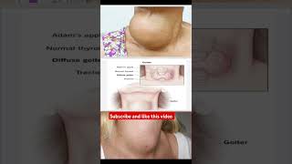 Goiter disease lack of iodine drugeducation medicalstudent [upl. by Anema]