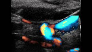 INTERNAL CAROTID ARTERY SPONTANEOUS DISSECTION [upl. by Thamora]