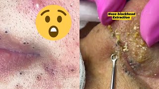 Pimple Popping Paradise A Satisfying Compilation [upl. by Imogen767]