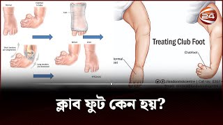 ক্লাব ফুট কেন হয়  Clubfoot  clubfoot treatment  Channel 24 [upl. by Fredelia282]