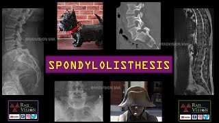 SPONDYLOLISTHESIS [upl. by Anaugal]