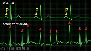 Atrial Fibrillation Anatomy ECG and Stroke Animation [upl. by Sajovich]