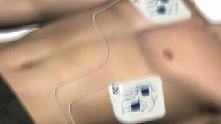 How to use an AED automated external defibrillator [upl. by Clive]