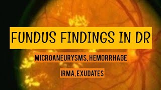 DIABETIC RETINOPATHY clinical findings  Microaneurysms hemorrhage irma hardexudates and more [upl. by Uolyram51]