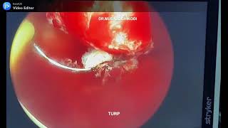 TRANSURETHRAL RESECTION TURP [upl. by O'Neill]