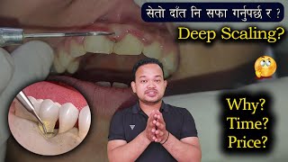 Deep Scaling भनेको के हो  किन जरुरि छ   Scaling price  Teeth cleaning  Scaling amp root planing [upl. by Margalit548]