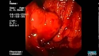 Endotherapy of Gastric Fundal Varices IntraVariceal Injection of NButyl2Cyanoacrylate [upl. by Rother]