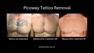 Picoway Laser for Tattoo and Brown Spot Removal [upl. by Cadmar]