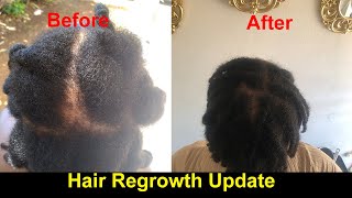 Recovering from Androgenic Alopecia Hair Regrowth Journey alopecia hairlosstreatment hairloss [upl. by Oiretule]