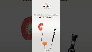 Minimally Invasive Treatment For KIDNEY STONES  Dr Khizar Raoof  Arete Hospitals [upl. by Ahsemo]