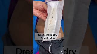 Hip replacement के बाद पहली पट्टी  dressing after hip replacement shortsindia [upl. by Adiaj]