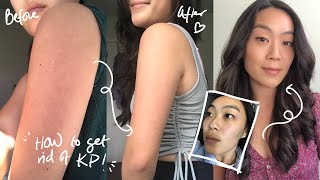 HOW I CLEARED MY KP KERATOSIS PILARIS amp ACNE  Before amp After [upl. by Fletcher]