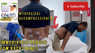 Myofascial Decompression “Cupping” for Low Back Pain [upl. by Aitnom]