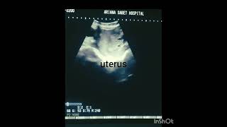 Right ovary septated cyst [upl. by Macey]