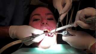 What Is It Like To Get A Filling In Your Tooth With Footage From The Dentists Office [upl. by Geiss]