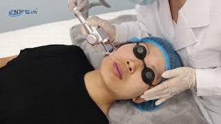 Fractional CO2 laser clinic treatment for skin rejuvenation [upl. by Centonze]