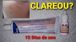 Resultado de 1 Mês Usando NistatinaÓleo de Rosa Mosqueta Pra Clarear Melasma e Manchas da Pele Acne [upl. by Treve102]