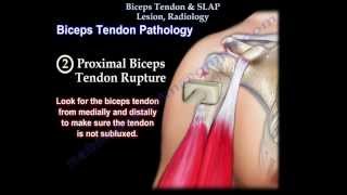 Biceps Tendon amp SLAP Lesion Radiology  Everything You Need To Know  Dr Nabil Ebraheim [upl. by Lomax]