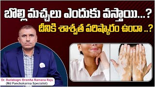 How to Cure Vitiligo Permanently in Telugu  Bolli Machalu Treatment  Vitiligo Natural Treatment [upl. by Karna164]