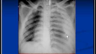 Chest xray interpretation hemothorax [upl. by Lehcer405]