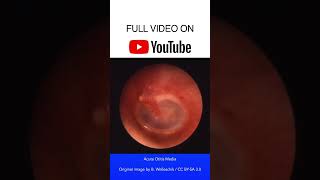 Acute Otitis Media Otoscopy [upl. by Ettenav]