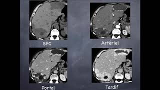 Tumeurs du foie  Bénignes  3 Hémangiome hépatique [upl. by Alexandria324]