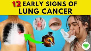 Spotting Lung Cancer Early 12 Warning Signs You Should Know  Lung Cancer Symptoms [upl. by Tiler]