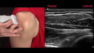 Ultrasound of the Shoulder [upl. by Eylatan]