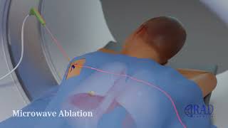 Lung Tumor Ablation Microwave vs Cryoablation [upl. by Kermit]