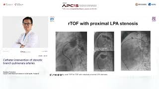 Catheter intervention of stenotic branch pulmonary arteries [upl. by Karb980]