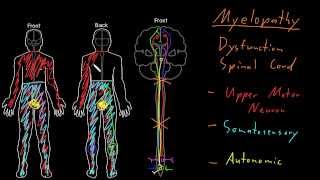 Syndrome Myelopathy [upl. by Anaz]