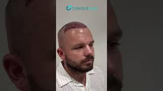 Amazing Results with Sapphire FUE Method  Ionel’s Hair Transplant at CLINIQUEPLUS [upl. by Gmur]