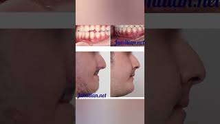 Before and After Orthodontic Treatment dentist bracing music dentalproblem openbite dentistry [upl. by Diraj]