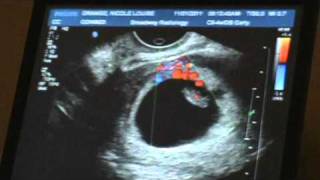 Ultrasound  7weeks 5 days Pregnant [upl. by Aroc]