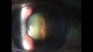 Posterior subcapsular cataract  Cararata subcapsular posterior [upl. by Nedah]