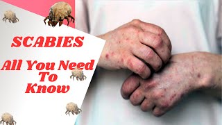 How To Identify amp Treat Scabies Causes Symptoms Prevention  Permethrin Ivermectin [upl. by Aitan80]