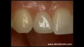 Carillas de Resina  Clinica Dental Krebs  Peru [upl. by Gnoh643]