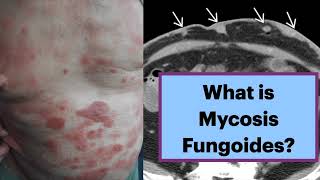 Mycosis Fungoides msk radiology lymphoma [upl. by Jorry]