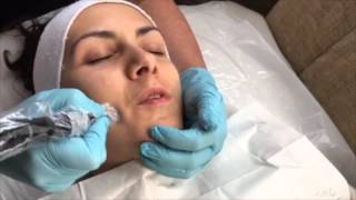 Collagen PIN Microneedling Skin Treatment by Qutis Witney [upl. by Ettesoj]