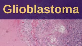 What is a Glioblastoma  Pathology mini tutorial [upl. by Phonsa]