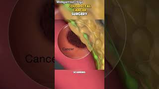 Colorectal cancer surgery  This is how colorectal cancer surgery is done gnmnursing gnm nursing [upl. by Alimaj]