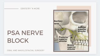 PSA POSTERIOR SUPERIOR ALVEOLAR  NERVE BLOCK [upl. by Lumbye]