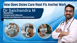 How Does Osteo Care Root Fix Anchor WorkDr Sai Chandra MBBS DNB Ortho Hyderabad [upl. by Ora]