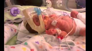 BABY BORN AT 26 WEEKS [upl. by Nooj]