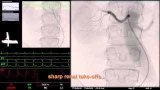 Mentice Renal Denervation [upl. by Anaerol67]