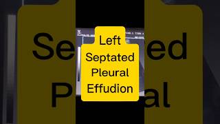 Septated Pleural Effusion  Lung Fluid  Dyspnoea ultrasound [upl. by Subak]